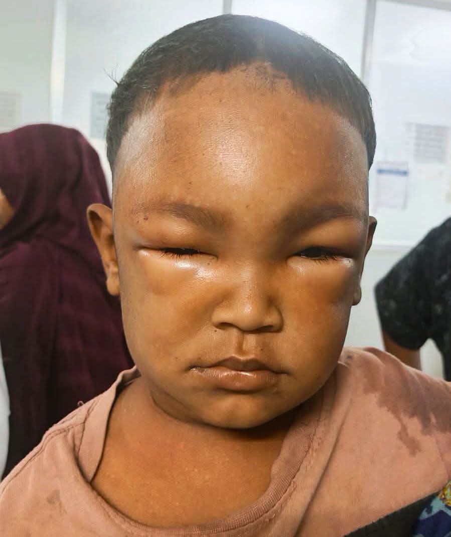 ভিমরুলের কামড়ে ৪ বছরের শিশু নিহত, আহত ২